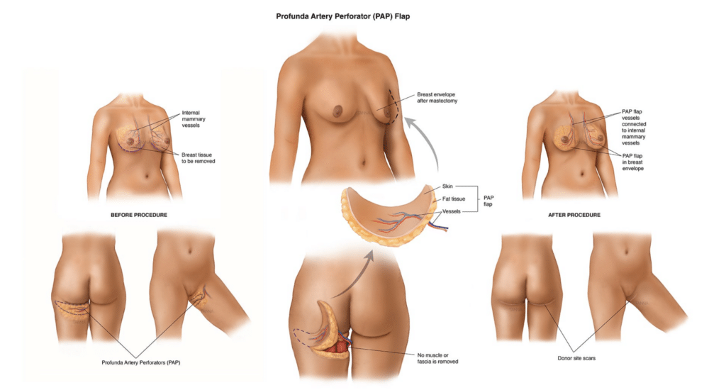 PAP breast reconstruction